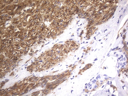c-Kit / CD117 Antibody - Immunohistochemical staining of paraffin-embedded Human gastric stromal tumor tissue using anti-KIT mouse monoclonal antibody. HIER pretreatment was done with 1mM EDTA in 10mM Tris buffer. (pH8.0) at 120°C for 2.5 minutes.was diluted 1:400 and detection was done with HRP secondary and DAB chromogen. Cytoplasmic and mebraneous stain seen in the tumor cells.