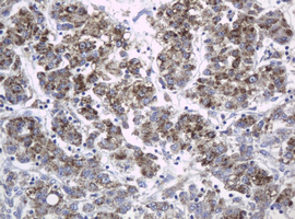 c-Kit / CD117 Antibody - IHC of paraffin-embedded Carcinoma of Human liver tissue using anti-KIT mouse monoclonal antibody. (Heat-induced epitope retrieval by 10mM citric buffer, pH6.0, 120°C for 3min).