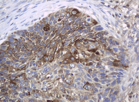 c-Kit / CD117 Antibody - IHC of paraffin-embedded Carcinoma of Human lung tissue using anti-KIT mouse monoclonal antibody. (Heat-induced epitope retrieval by 10mM citric buffer, pH6.0, 120°C for 3min).