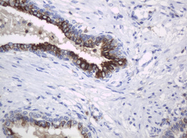 c-Kit / CD117 Antibody - IHC of paraffin-embedded Carcinoma of Human prostate tissue using anti-KIT mouse monoclonal antibody. (Heat-induced epitope retrieval by 10mM citric buffer, pH6.0, 120°C for 3min).