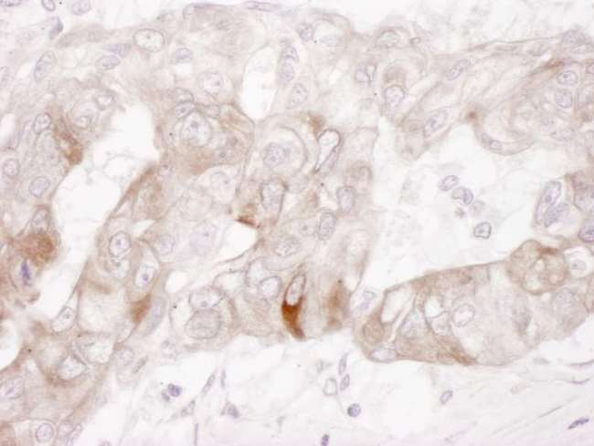 c-Kit / CD117 Antibody - Detection of Human c-Kit by Immunohistochemistry. Sample: FFPE section of human ovarian carcinoma. Antibody: Affinity purified rabbit anti-c-Kit used at a dilution of 1:1000 (1 ug/ml). Detection: DAB.