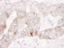 c-Kit / CD117 Antibody - Detection of Human c-Kit by Immunohistochemistry. Sample: FFPE section of human ovarian carcinoma. Antibody: Affinity purified rabbit anti-c-Kit used at a dilution of 1:1000 (1 ug/ml). Detection: DAB.