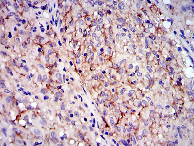c-Kit / CD117 Antibody - IHC of paraffin-embedded gastrointestinal stromal tumor using KIT mouse monoclonal antibody with DAB staining.