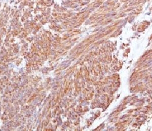 c-Kit / CD117 Antibody - IHC testing of FFPE human gastrointestinal stromal tumor (GIST) and CD117 antibody (CLDA117).  This image was taken for the unmodified form of this product. Other forms have not been tested.
