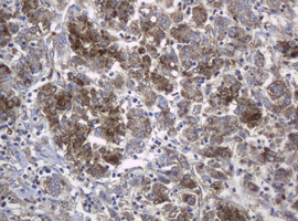 c-Kit / CD117 Antibody - IHC of paraffin-embedded Carcinoma of Human liver tissue using anti-KIT mouse monoclonal antibody.