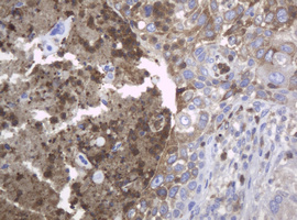c-Kit / CD117 Antibody - IHC of paraffin-embedded Carcinoma of Human lung tissue using anti-KIT mouse monoclonal antibody.