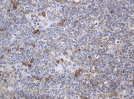 c-Kit / CD117 Antibody - IHC of paraffin-embedded Human lymphoma tissue using anti-KIT mouse monoclonal antibody.