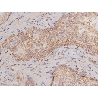 c-Kit / CD117 Antibody - 1:200 staining human prostate tissue by IHC-P. The tissue was formaldehyde fixed and a heat mediated antigen retrieval step in citrate buffer was performed. The tissue was then blocked and incubated with the antibody for 1.5 hours at 22°C. An HRP conjugated goat anti-rabbit antibody was used as the secondary.