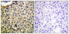 c-Kit / CD117 Antibody - Immunohistochemistry analysis of paraffin-embedded human breast carcinoma, using KIT (Phospho-Tyr703) Antibody. The picture on the right is blocked with the phospho peptide.