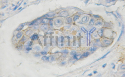 c-Kit / CD117 Antibody - 1/100 staining human breast carcinoma tissue by IHC-P. The sample was formaldehyde fixed and a heat mediated antigen retrieval step in citrate buffer was performed. The sample was then blocked and incubated with the antibody for 1.5 hours at 22°C. An HRP conjugated goat anti-rabbit antibody was used as the secondary antibody.