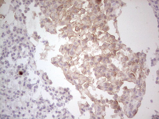 c-Met Antibody - Immunohistochemical staining of paraffin-embedded MET positive Human lung carcinoma tissue using anti-MET mouse monoclonal antibody.  heat-induced epitope retrieval by 1 mM EDTA in 10mM Tris, pH8.5, 120C for 3min)