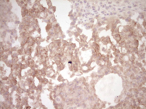 c-Met Antibody - Immunohistochemical staining of paraffin-embedded MET positive Human lung carcinoma tissue using anti-MET mouse monoclonal antibody.  Dilution: 1:150