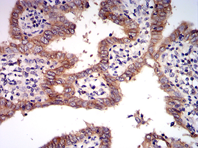 c-Met Antibody - Immunohistochemical analysis of paraffin-embedded endometrial cancer tissues using MET mouse mAb with DAB staining.