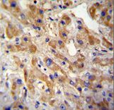 c-Met Antibody - MET/HGFR Antibody immunohistochemistry of formalin-fixed and paraffin-embedded human hepatocarcinoma followed by peroxidase-conjugated secondary antibody and DAB staining.