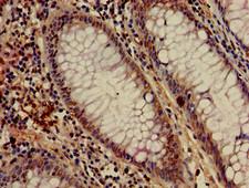 c-Met Antibody - Immunohistochemistry of paraffin-embedded human colon cancer using MET Antibody at dilution of 1:100