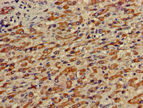 c-Met Antibody - Immunohistochemistry of paraffin-embedded human liver cancer using MET Antibody at dilution of 1:100