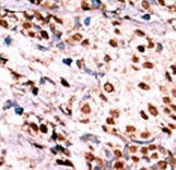 c-Met Antibody - Formalin-fixed and paraffin-embedded human cancer tissue reacted with the primary antibody, which was peroxidase-conjugated to the secondary antibody, followed by AEC staining. This data demonstrates the use of this antibody for immunohistochemistry; clinical relevance has not been evaluated. BC = breast carcinoma; HC = hepatocarcinoma.