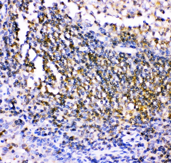 c-Src Kinase / CSK Antibody - IHC analysis of CSK using anti-CSK antibody. CSK was detected in paraffin-embedded section of human tonsil tissues. Heat mediated antigen retrieval was performed in citrate buffer (pH6, epitope retrieval solution) for 20 mins. The tissue section was blocked with 10% goat serum. The tissue section was then incubated with 1µg/ml rabbit anti-CSK Antibody overnight at 4°C. Biotinylated goat anti-rabbit IgG was used as secondary antibody and incubated for 30 minutes at 37°C. The tissue section was developed using Strepavidin-Biotin-Complex (SABC) with DAB as the chromogen.