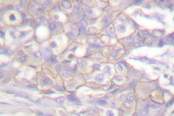 c-Src Kinase / CSK Antibody - IHC of Csk (L558) pAb in paraffin-embedded human breast carcinoma tissue.