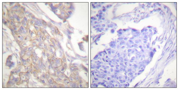 c-Src Kinase / CSK Antibody - Peptide - + Immunohistochemistry analysis of paraffin-embedded human breast carcinoma tissue using Csk (Ab-364) antibody.