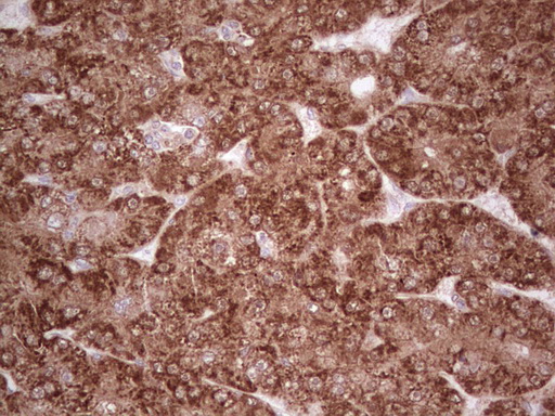 C-TAK1 / MARK3 Antibody - Immunohistochemical staining of paraffin-embedded Carcinoma of Human liver tissue using anti-MARK3 mouse monoclonal antibody. (Heat-induced epitope retrieval by 1 mM EDTA in 10mM Tris, pH8.5, 120C for 3min,