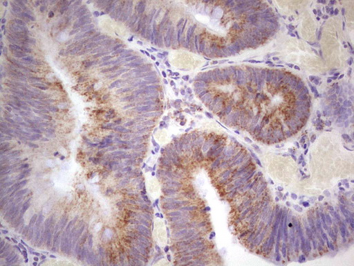 C-TAK1 / MARK3 Antibody - Immunohistochemical staining of paraffin-embedded Adenocarcinoma of Human colon tissue using anti-MARK3 mouse monoclonal antibody.  heat-induced epitope retrieval by 1 mM EDTA in 10mM Tris, pH8.5, 120C for 3min)