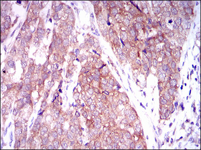 C-TAK1 / MARK3 Antibody - IHC of paraffin-embedded bladder cancer tissues using MARK3 mouse monoclonal antibody with DAB staining.