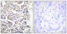 C-TAK1 / MARK3 Antibody - Peptide - + Immunohistochemistry analysis of paraffin-embedded human lung carcinoma tissue using MARK3 antibody.
