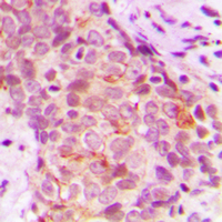 C-TAK1 / MARK3 Antibody - Immunohistochemical analysis of MARK3 staining in human breast cancer formalin fixed paraffin embedded tissue section. The section was pre-treated using heat mediated antigen retrieval with sodium citrate buffer (pH 6.0). The section was then incubated with the antibody at room temperature and detected using an HRP conjugated compact polymer system. DAB was used as the chromogen. The section was then counterstained with hematoxylin and mounted with DPX.