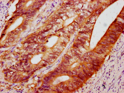 C10orf10 Antibody - Immunohistochemistry Dilution at 1:400 and staining in paraffin-embedded human colon cancer performed on a Leica BondTM system. After dewaxing and hydration, antigen retrieval was mediated by high pressure in a citrate buffer (pH 6.0). Section was blocked with 10% normal Goat serum 30min at RT. Then primary antibody (1% BSA) was incubated at 4°C overnight. The primary is detected by a biotinylated Secondary antibody and visualized using an HRP conjugated SP system.