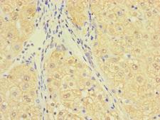 C10orf111 Antibody - Immunohistochemistry of paraffin-embedded human liver cancer using C10orf111 Antibody at dilution of 1:100