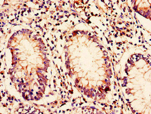 C10orf32 Antibody - Immunohistochemistry of paraffin-embedded human colon cancer using BORCS7 Antibody at dilution of 1:100