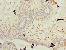 C10orf62 Antibody - Immunohistochemistry of paraffin-embedded human breast cancer using antibody at dilution of 1:100.