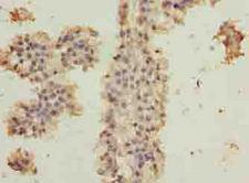 C10orf82 Antibody - Immunohistochemistry of paraffin-embedded human breast cancer using antibody at dilution of 1:100.