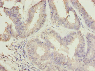 C10orf82 Antibody - Immunohistochemistry of paraffin-embedded human endometrial cancer using C10orf82 Antibody at dilution of 1:100