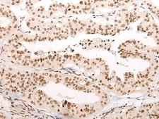 C11orf2 / Fat-Free Antibody - Immunohistochemistry of paraffin-embedded Human liver cancer tissue  using VPS51 Polyclonal Antibody at dilution of 1:65(×200)