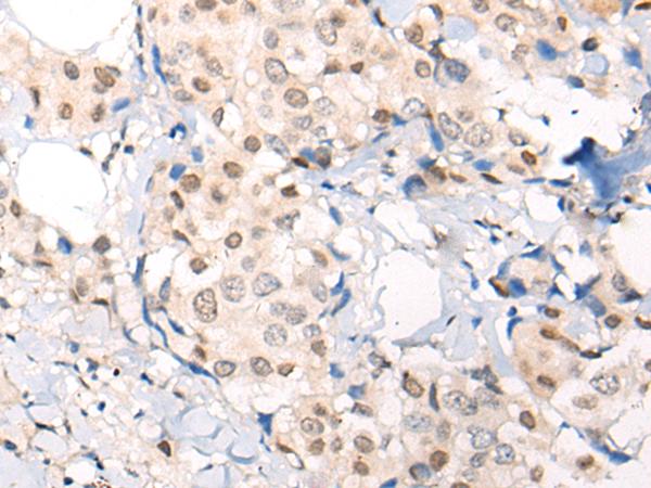 C11orf2 / Fat-Free Antibody - Immunohistochemistry of paraffin-embedded Human breast cancer tissue  using VPS51 Polyclonal Antibody at dilution of 1:65(×200)