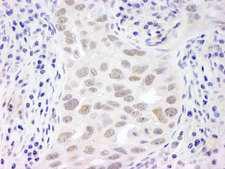 C11orf30 / EMSY Antibody - Detection of Human EMSY by Immunohistochemistry. Sample: FFPE section of human breast carcinoma Antibody: Affinity purified rabbit anti-EMSY used at a dilution of 1:250.