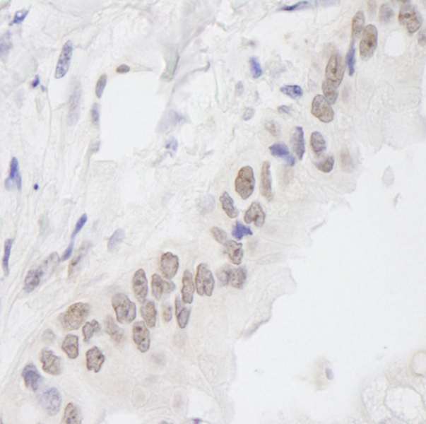 C11orf30 / EMSY Antibody - Detection of Human EMSY by Immunohistochemistry. Sample: FFPE section of human stomach adenocarcinoma Antibody: Affinity purified rabbit anti-EMSY used at a dilution of 1:250.