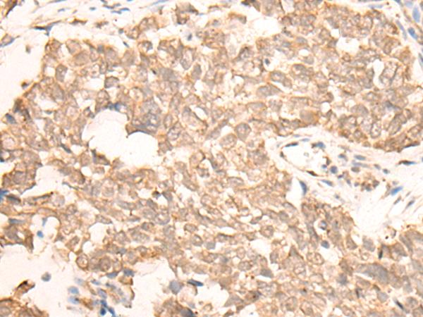 C11orf30 / EMSY Antibody - Immunohistochemistry of paraffin-embedded Human lung cancer tissue  using EMSY Polyclonal Antibody at dilution of 1:25(×200)