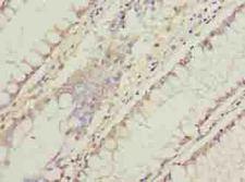 C11orf53 Antibody - Immunohistochemistry of paraffin-embedded human colon cancer using antibody at dilution of 1:100.