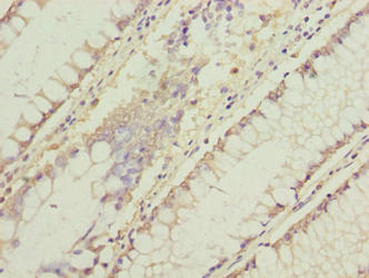 C11orf53 Antibody - Immunohistochemistry of paraffin-embedded human colon cancer using C11orf53 Antibody at dilution of 1:100