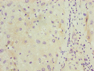 C11orf53 Antibody - Immunohistochemistry of paraffin-embedded human liver cancer using C11orf53 Antibody at dilution of 1:100