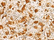 C11orf54 Antibody - Immunohistochemistry of paraffin-embedded Human liver cancer tissue  using C11orf54 Polyclonal Antibody at dilution of 1:50(×200)