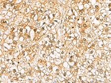 C11orf54 Antibody - Immunohistochemistry of paraffin-embedded Human liver cancer tissue  using C11orf54 Polyclonal Antibody at dilution of 1:70(×200)