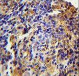 C11orf73 Antibody - CK073 Antibody immunohistochemistry of formalin-fixed and paraffin-embedded human lung carcinoma followed by peroxidase-conjugated secondary antibody and DAB staining.