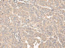 C12orf40 Antibody - Immunohistochemistry of paraffin-embedded Human liver cancer tissue  using C12orf40 Polyclonal Antibody at dilution of 1:50(×200)