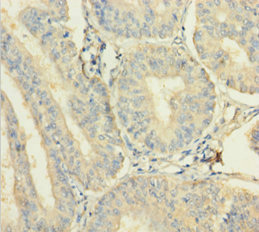 C12orf49 Antibody - Immunohistochemistry of paraffin-embedded human endometrial cancer using C12orf49 Antibody at dilution of 1:100