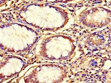 C12orf65 Antibody - Immunohistochemistry of paraffin-embedded human colon cancer at dilution 1:100
