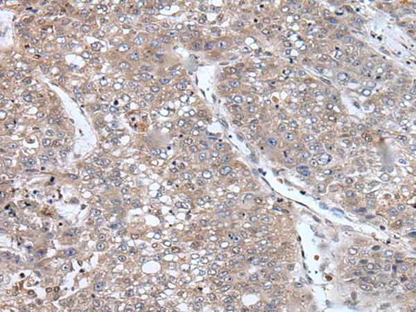 C13orf34 / BORA Antibody - Immunohistochemistry of paraffin-embedded Human liver cancer tissue  using BORA Polyclonal Antibody at dilution of 1:105(×200)